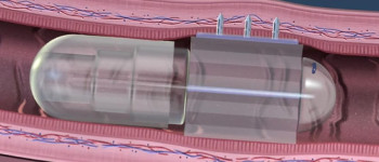 Ця «пігулка» вирощує голки, щоб вводити ліки в ваше тіло