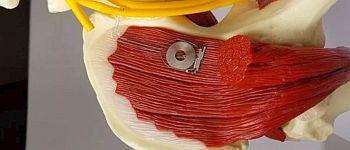 Цей бездротовий імплантат лікує пошкоджені нерви, а потім саморуйнується