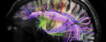  Вперше в історії ультразвук використали для "запуску" мозка пацієнта в комі