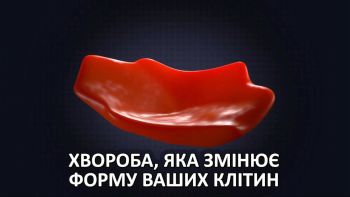 Хвороба, яка змінює форму ваших клітин