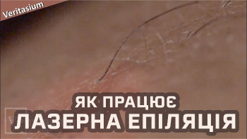 Як працює лазерна епіляція
